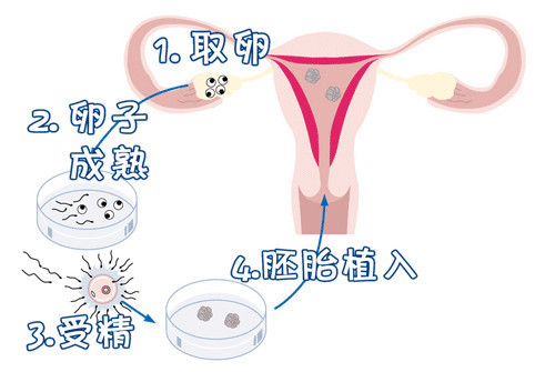 着床前診断 PGT